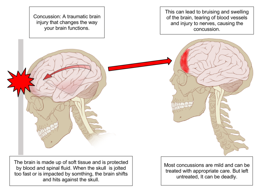 A concussion is a traumatic brain injury that changes the way your brain functions, commons.wikimedia.org